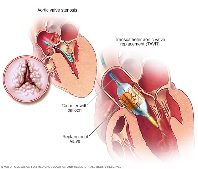 Valve implantation through the tip of the heart