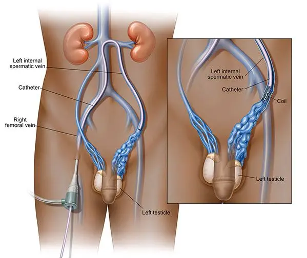 Varicocele &#8211; symptoms, treatment, surgery