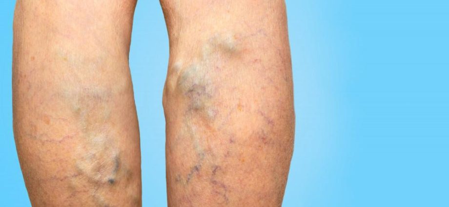 Varicose veins &#8211; a problem not only cosmetic