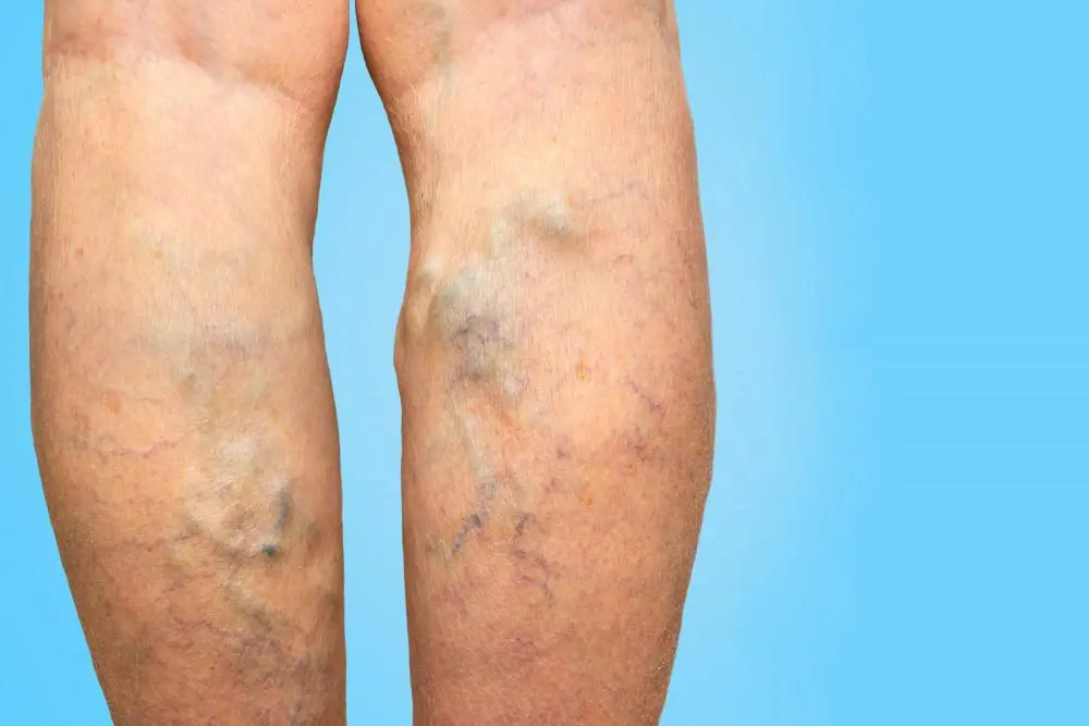 Varicose veins &#8211; a problem not only cosmetic