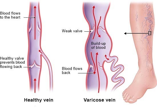 Varicose veins &#8211; epidemiology, causes, symptoms, treatment, appearance