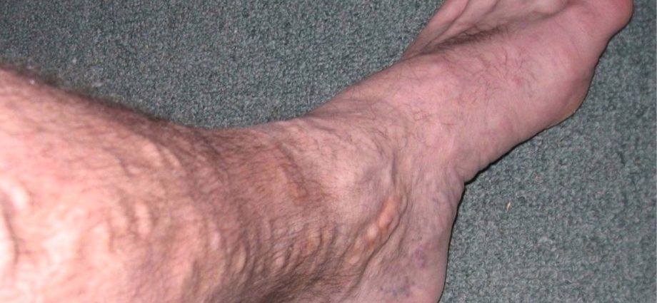 Varicose veins of the lower extremities