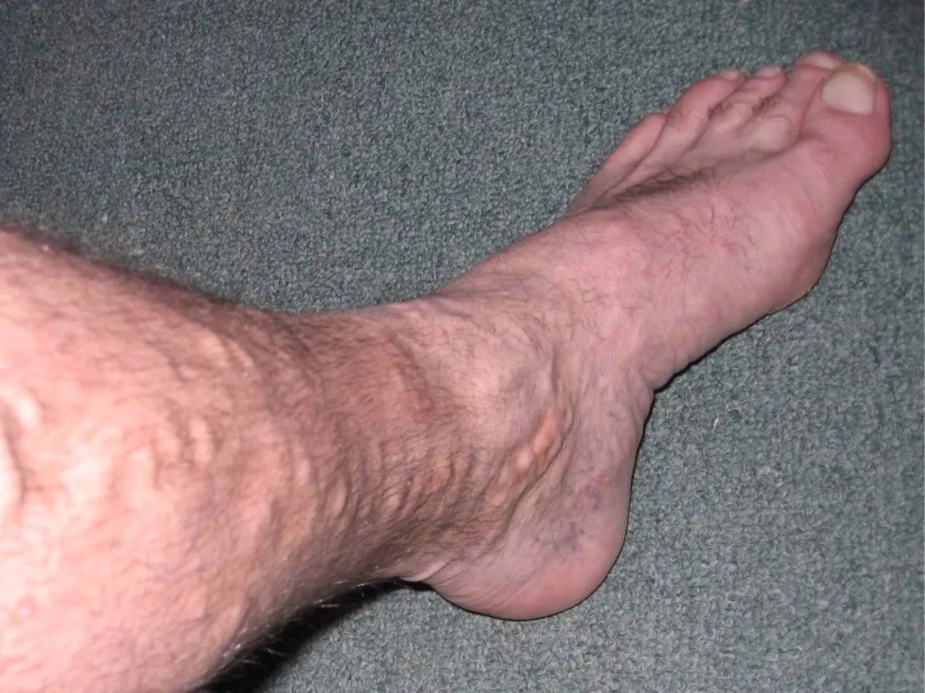 Varicose veins of the lower extremities