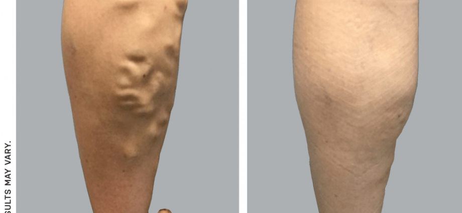 Varicose veins removal