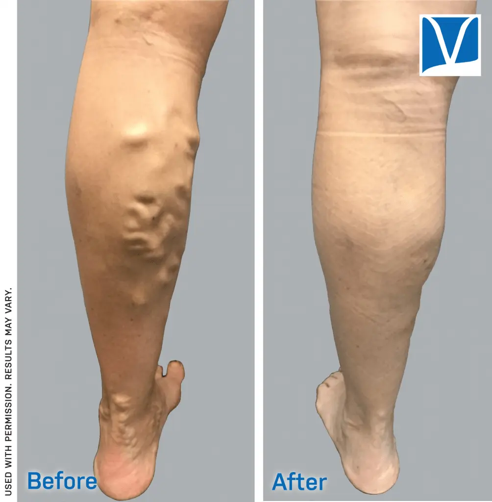 Varicose veins removal