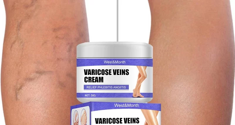 Varicose veins &#8211; will the varicose ointment cure?