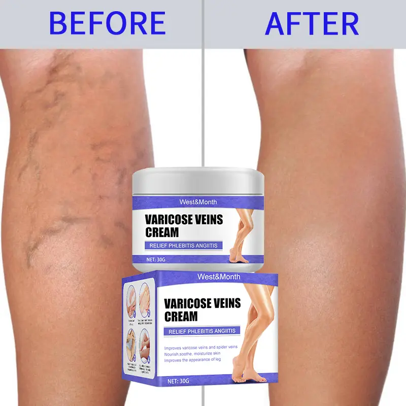 Varicose veins &#8211; will the varicose ointment cure?