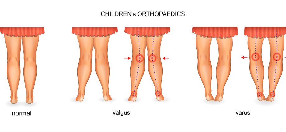 Varus knees &#8211; causes, symptoms, diagnosis, treatment