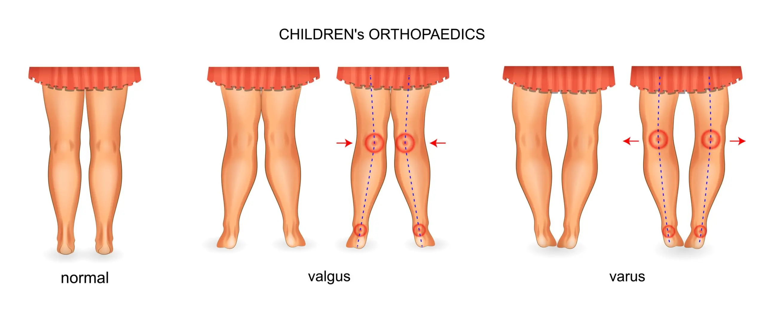 Varus knees &#8211; causes, symptoms, diagnosis, treatment