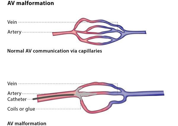 Vascular malformation &#8211; causes, symptoms, types and methods of treatment