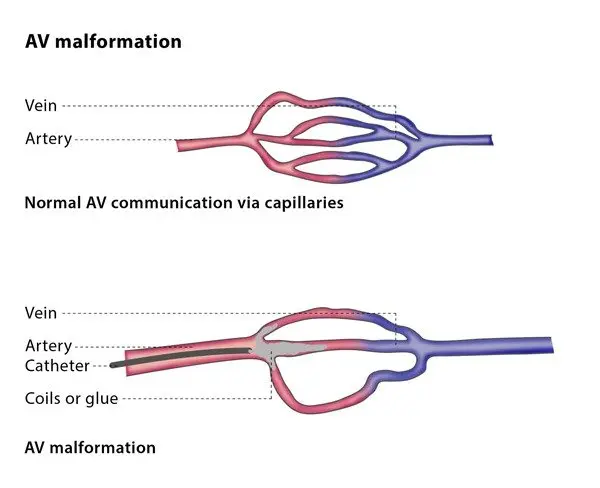 Vascular malformation &#8211; causes, symptoms, types and methods of treatment