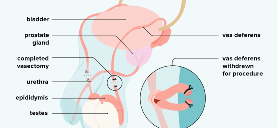 Vasectomy &#8211; effectiveness, reversibility and side effects of the procedure [EXPLAINED]