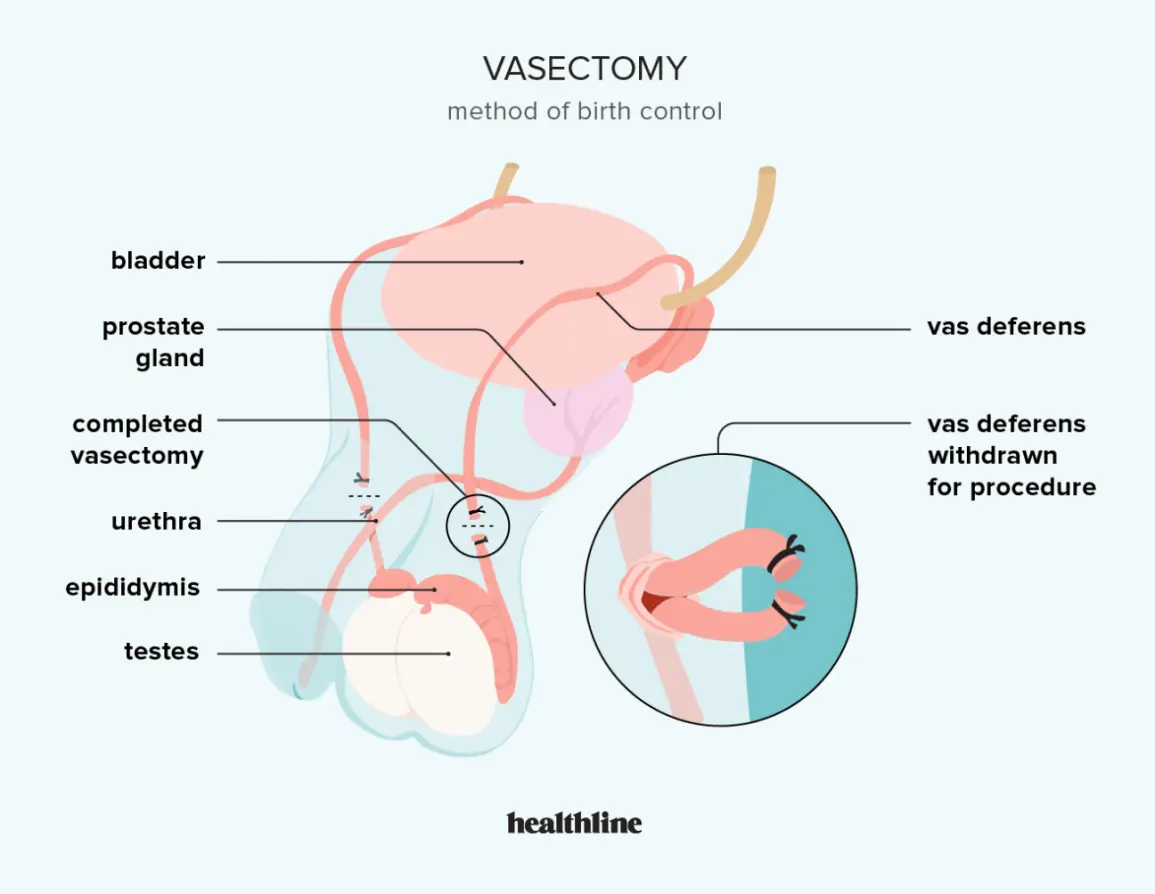 Vasectomy &#8211; effectiveness, reversibility and side effects of the procedure [EXPLAINED]