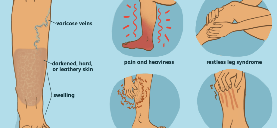 Venous edema – sanhi, sintomas at paggamot ng venous edema