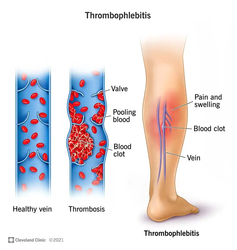 Venous thrombosis &#8211; symptoms and treatment of thrombophlebitis