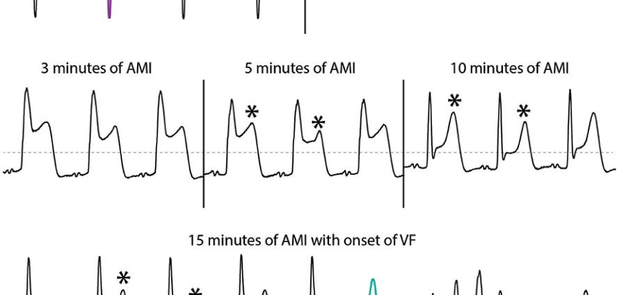 Ventricular fibrillation &#8211; Too late help can be fatal