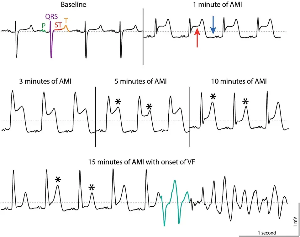 Ventricular fibrillation &#8211; Too late help can be fatal