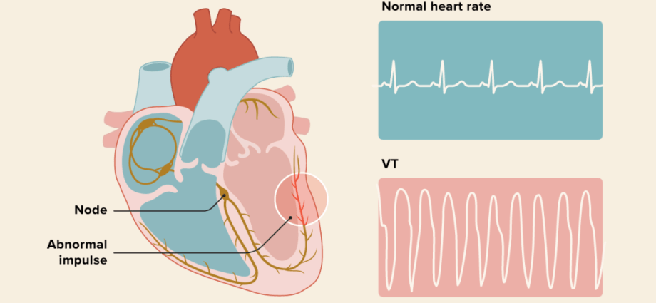 Ventricular tachycardia &#8211; what causes it? How to heal?