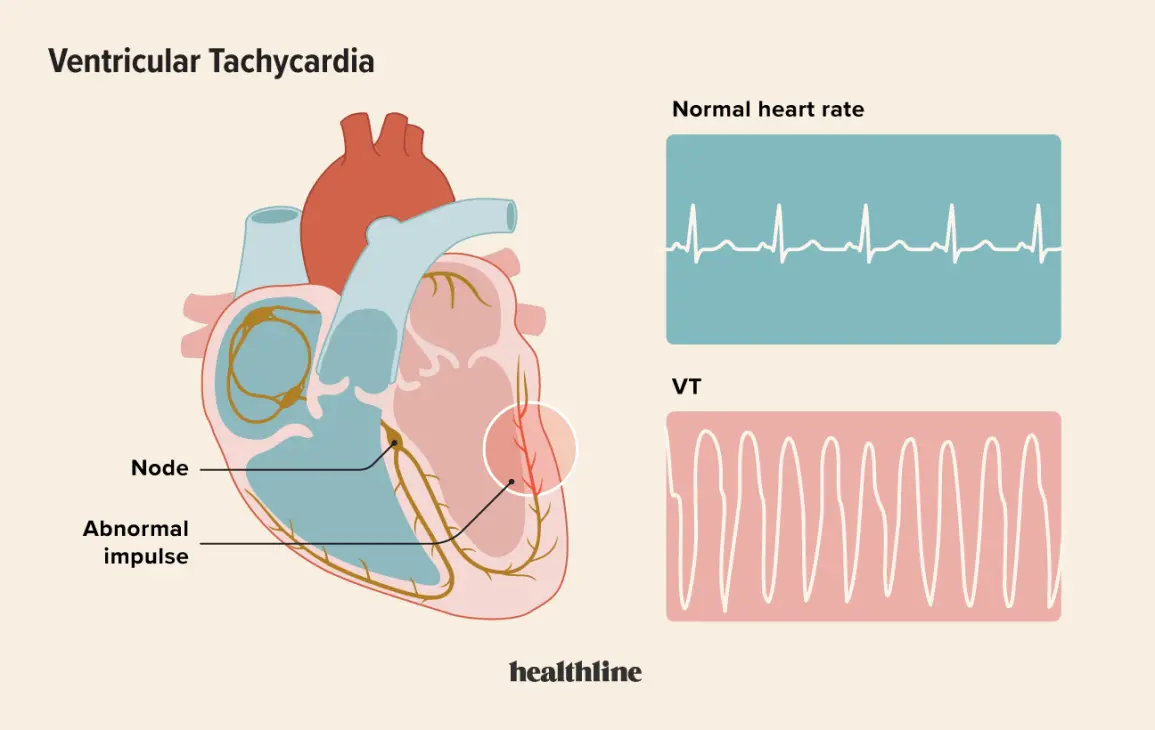 Ventricular tachycardia &#8211; what causes it? How to heal?