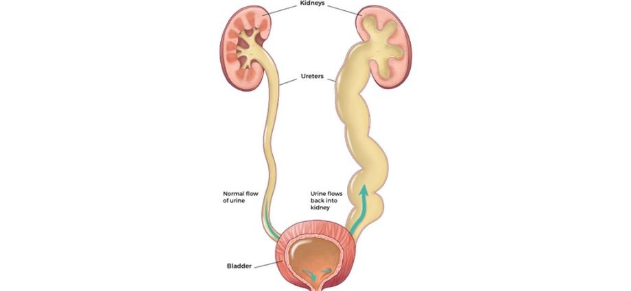 Vesicoureteral reflux