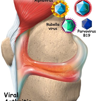 Viral arthritis