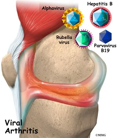 Viral arthritis