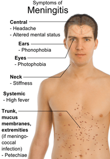 Viral meningitis