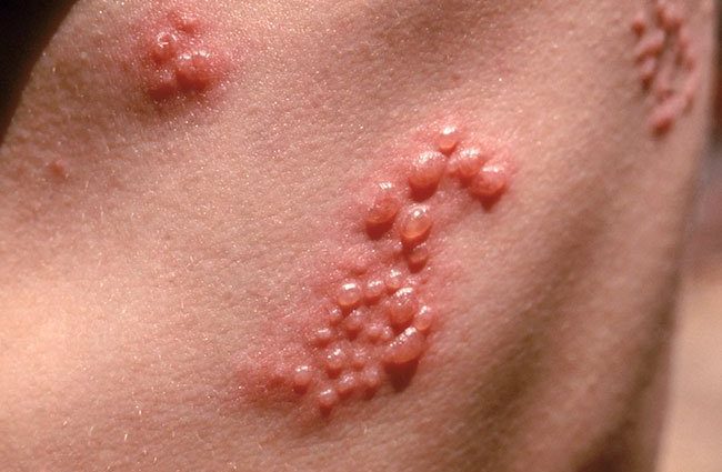 Viral skin diseases. Herpes, shingles, genital warts, skin warts