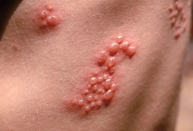 Viral skin diseases. Herpes, shingles, genital warts, skin warts