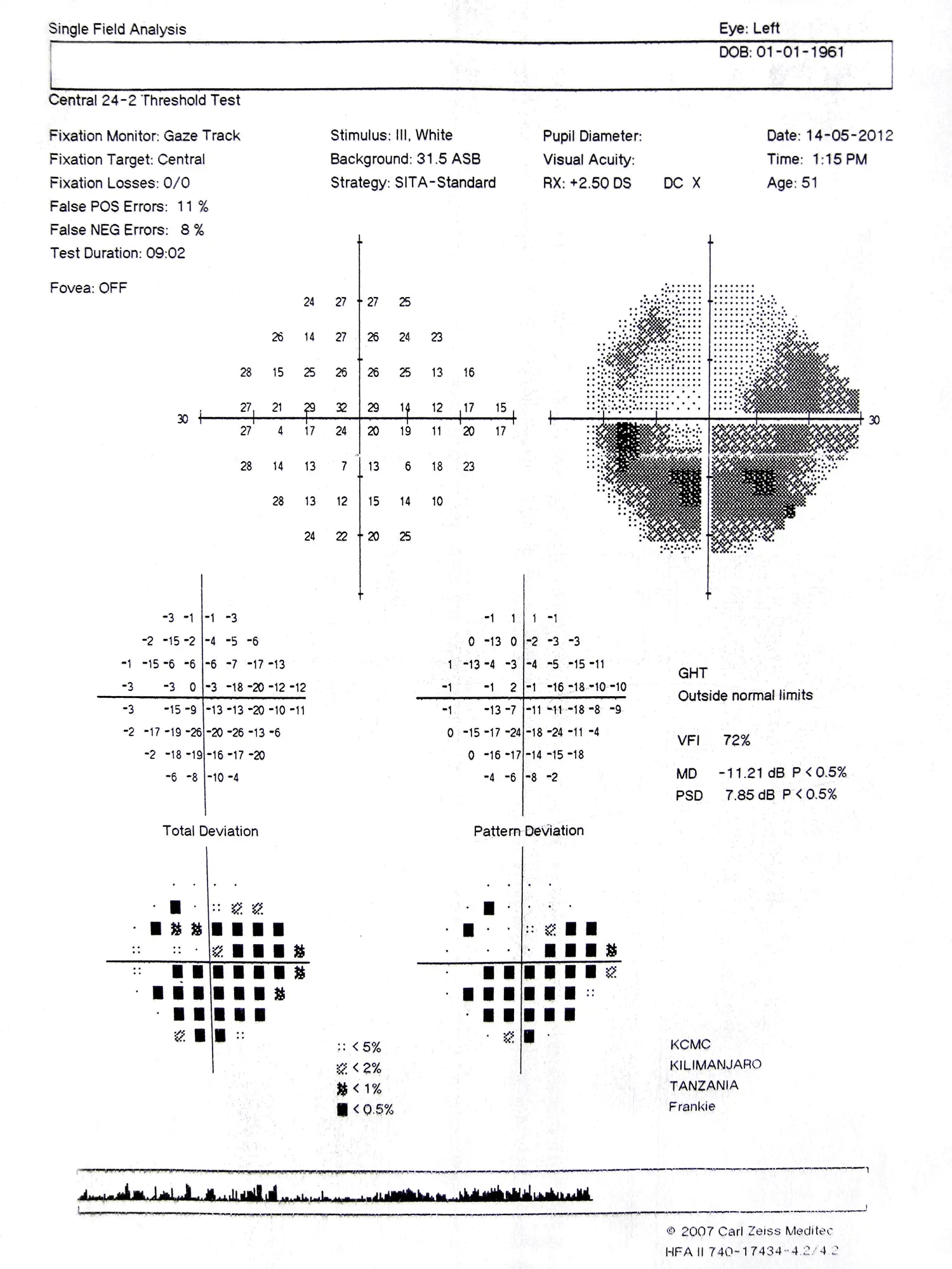 Visual field testing &#8211; what is it? Standards and results