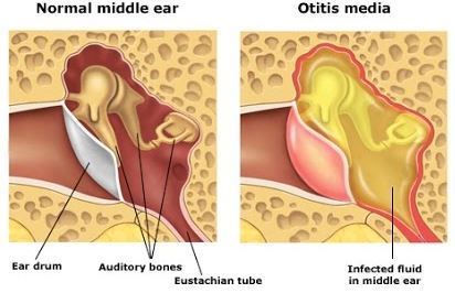 Vitamin D lowers the risk of recurring ear infections in children