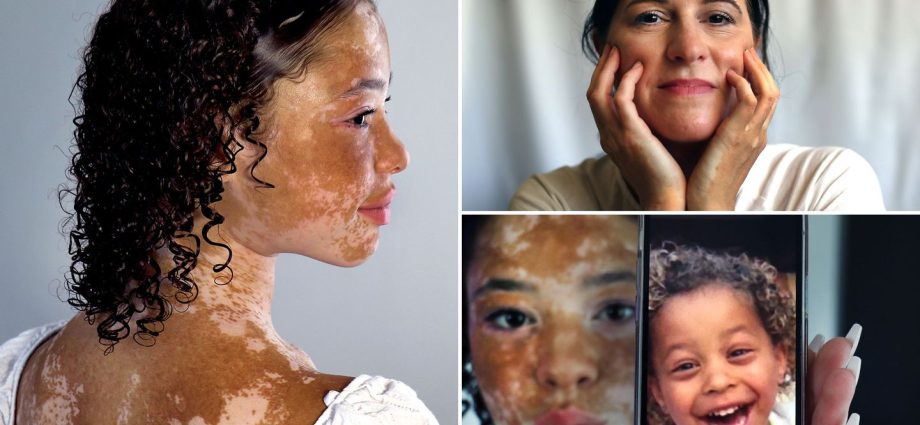 Vitiligo &#8211; a form of the disease. Treatment of vitiligo