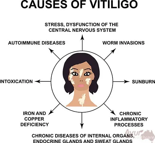 Vitiligo &#8211; causes, types, symptoms, prognosis. How To Treat Vitiligo?