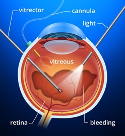 Vitrectomy &#8211; indications for surgery. What does eye retinal surgery look like?