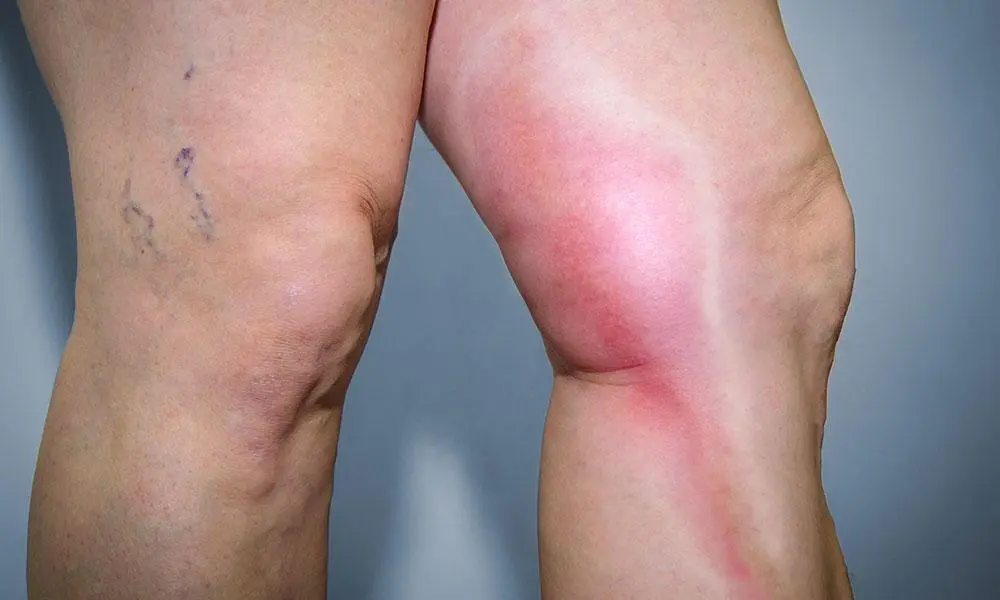 Wandering superficial thrombophlebitis