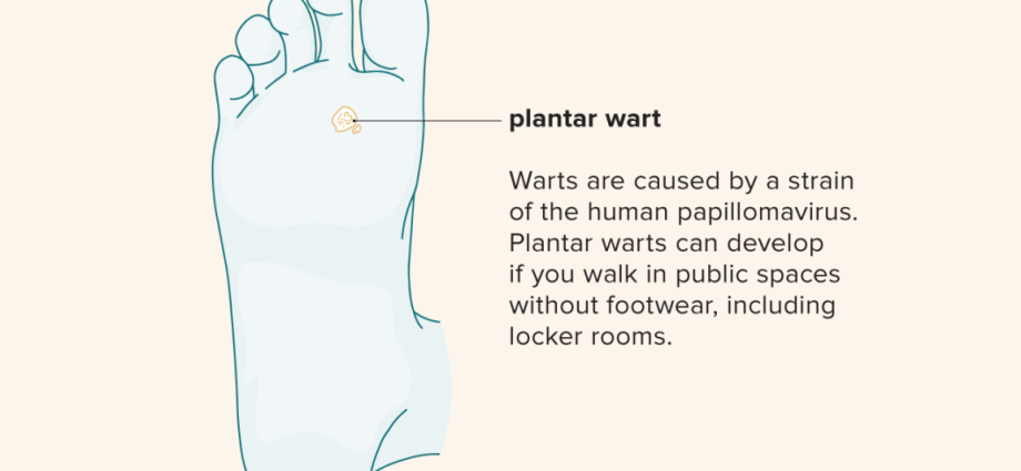 Wart on the foot &#8211; causes, treatment, home remedies for warts on the feet