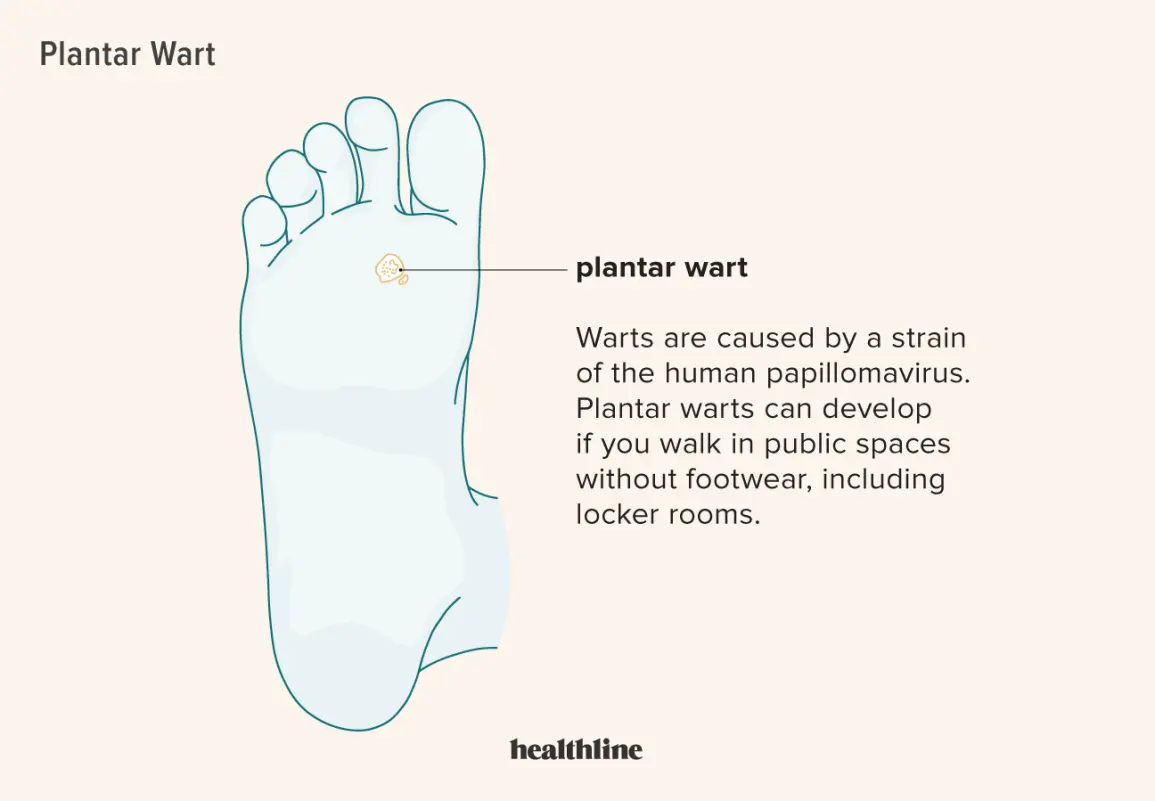 Wart on the foot &#8211; causes, treatment, home remedies for warts on the feet