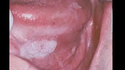 Watch out for HPV. Human papillomavirus and oral cancer