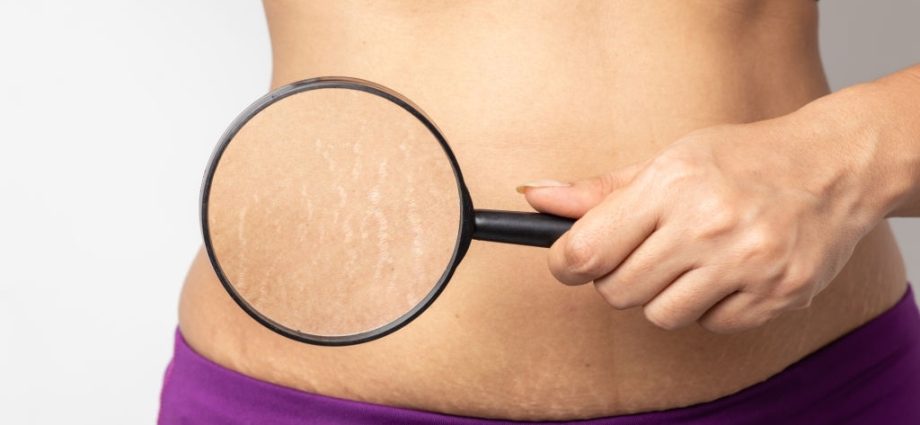 Water cellulite &#8211; why does it appear? Methods of preventing cellulite on the abdomen