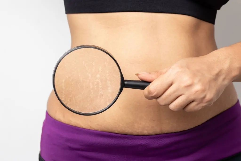 Water cellulite &#8211; why does it appear? Methods of preventing cellulite on the abdomen