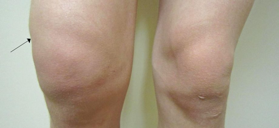 Water in the knee &#8211; causes, symptoms, treatment. Who may be affected by this problem?