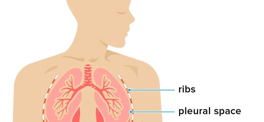 Water in the lungs (pleural fluid)