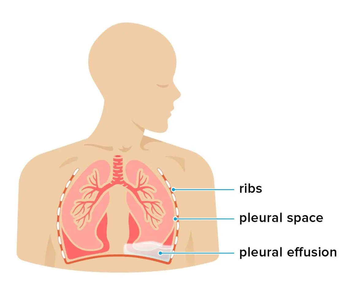 Water in the lungs (pleural fluid)