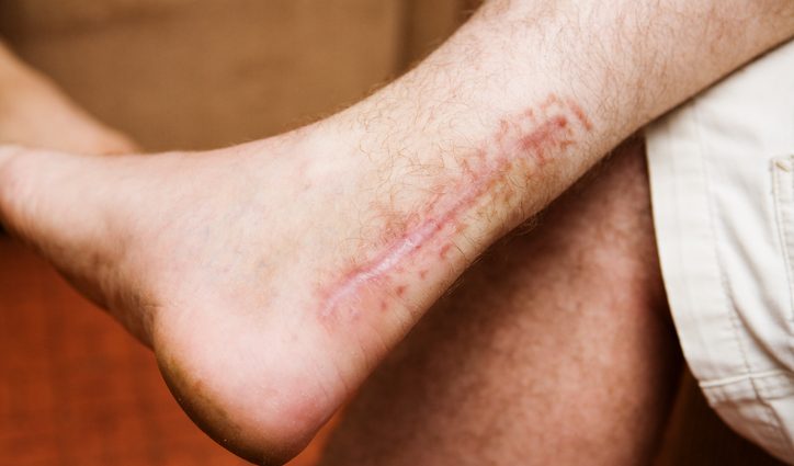 We debunk the six biggest myths about scarring