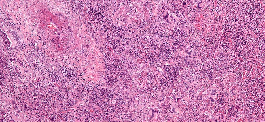 Wegener&#8217;s Granulomatosis &#8211; a killer vasculitis