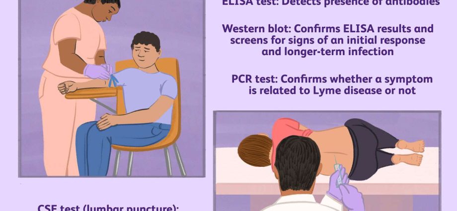 Western Blot test &#8211; indications, interpretation of results and price. Diagnosis of Lyme disease, HIV and herpes