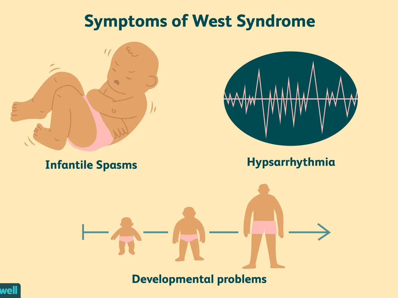 West&#8217;s syndrome &#8211; what is it, causes, symptoms, treatment