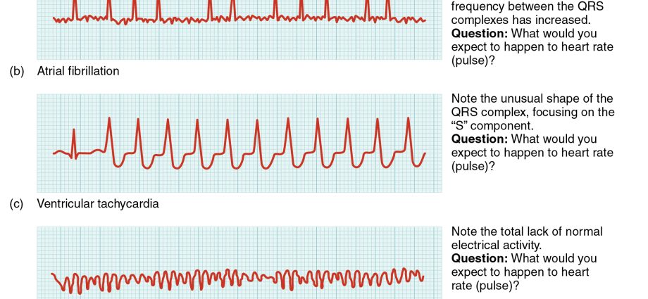 What are arrhythmias?