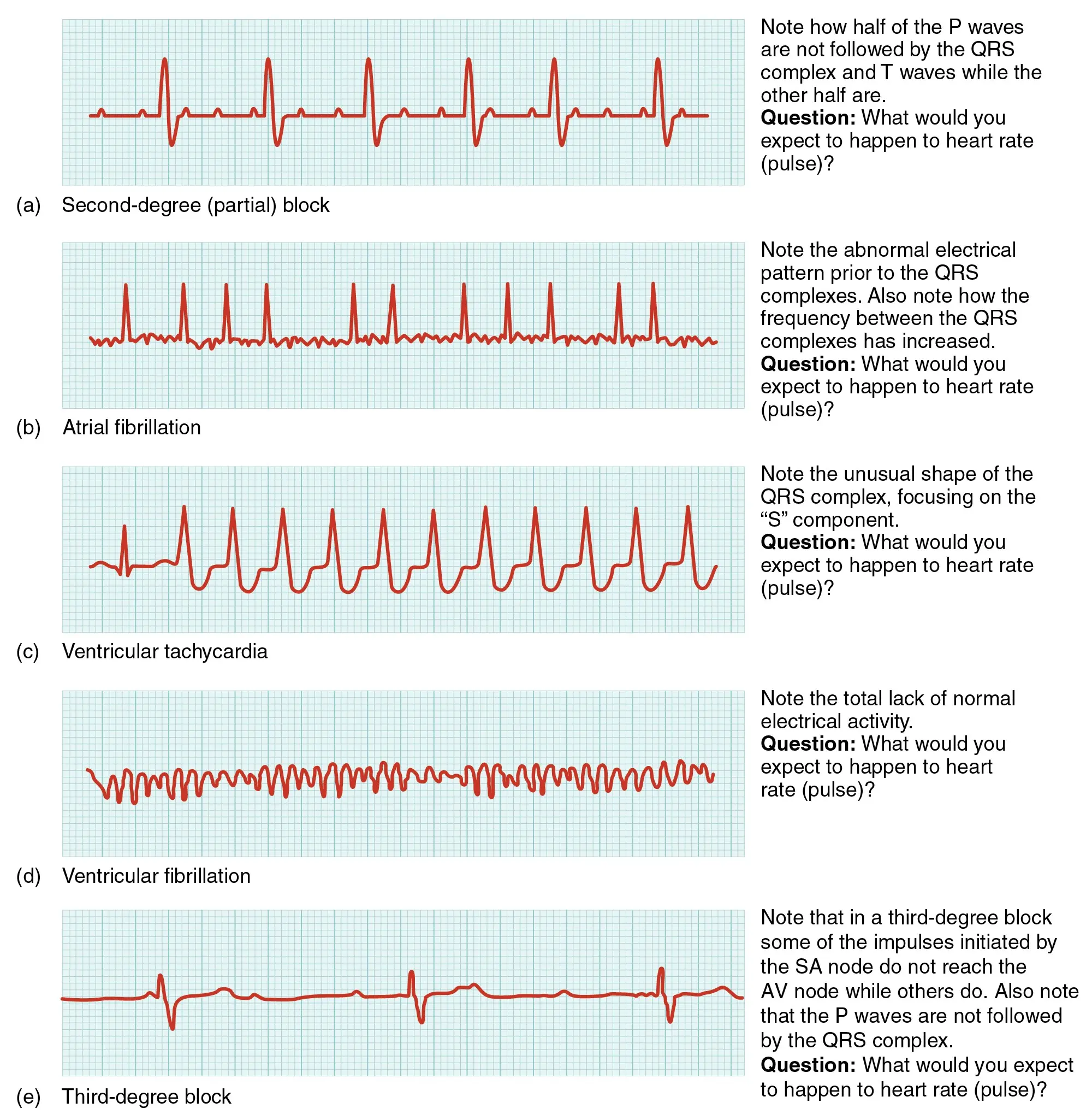 What are arrhythmias?