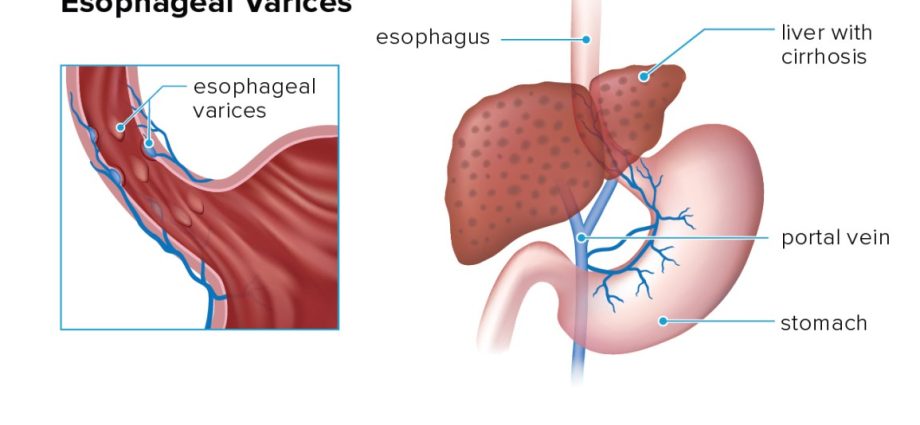 What are esophageal varices? Kamil Durczok suffered from it